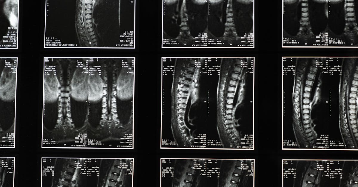 découvrez les causes, symptômes et traitements de la sciatique. apprenez comment soulager la douleur et améliorer votre qualité de vie grâce à des conseils d'experts et des solutions adaptées.