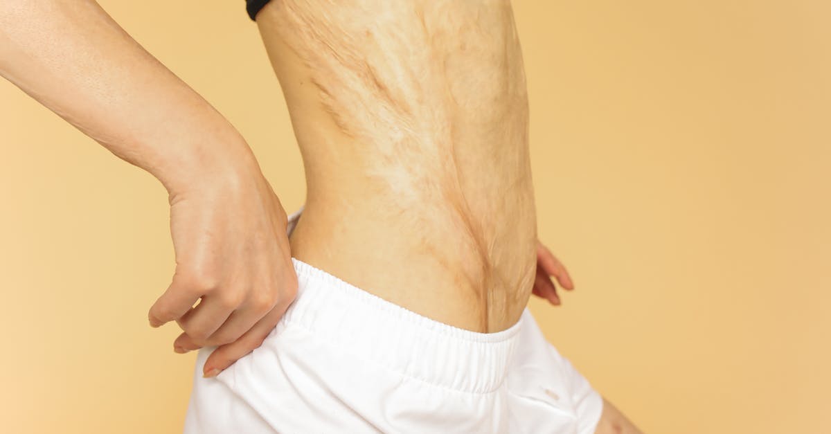 découvrez tout sur les vergetures : causes, traitements, et conseils pour les prévenir. apprenez à prendre soin de votre peau et à minimiser l'apparence des vergetures avec nos astuces pratiques.