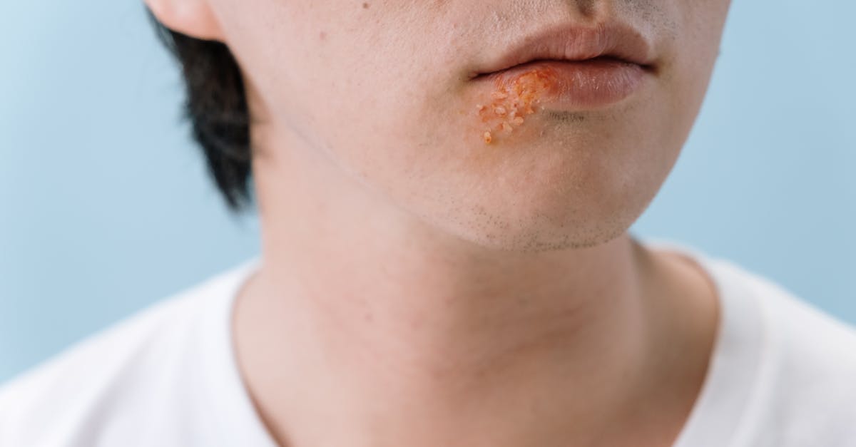 découvrez tout ce que vous devez savoir sur les aphtes et les lésions buccales : causes, symptômes, traitements et conseils pour soulager la douleur. apprenez à prévenir leur apparition et à maintenir une bonne santé bucco-dentaire.
