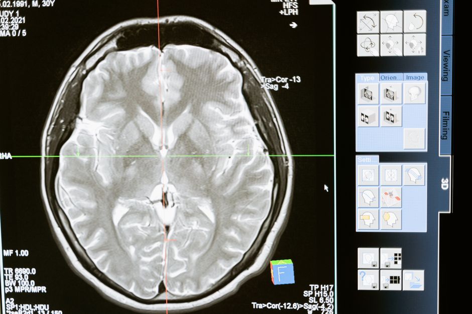 Amour romantique : 3 mythes sur le cerveau amoureux Intricate MRI brain scan displayed on a computer screen for medical analysis and diagnosis.