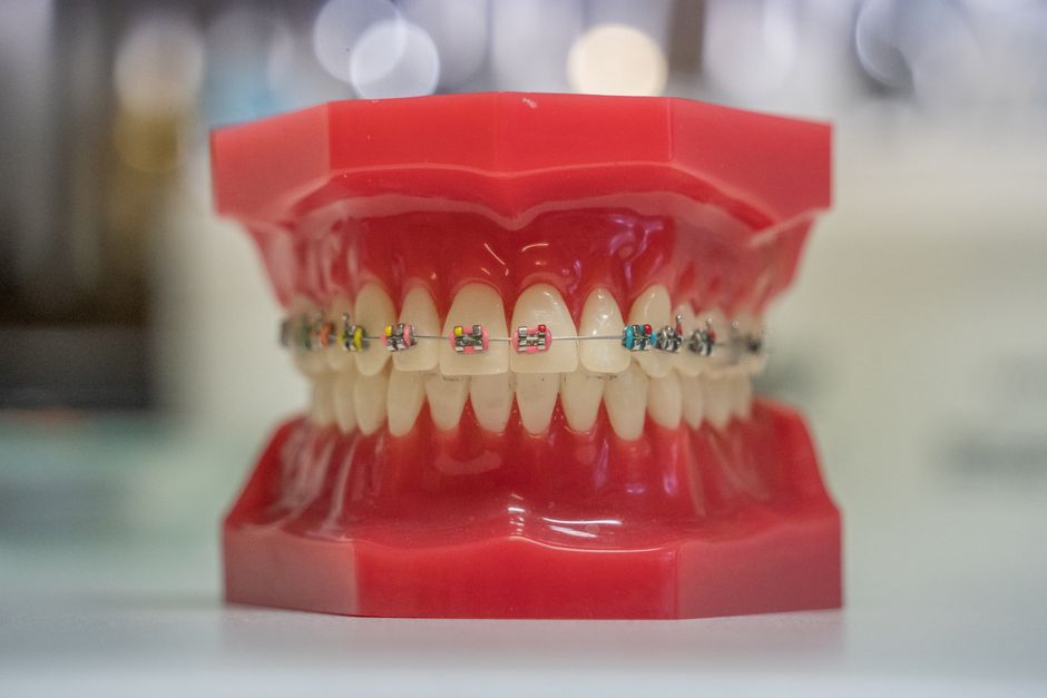 Taches blanches et appareil dentaire : 40 prémolaires testées, la finition sous surveillance Model of human teeth with colorful braces, showcasing dental care and orthodontics.